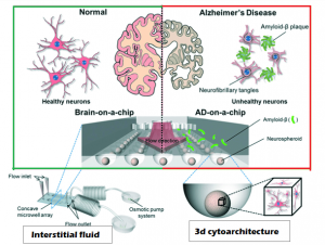 Alzheimer's