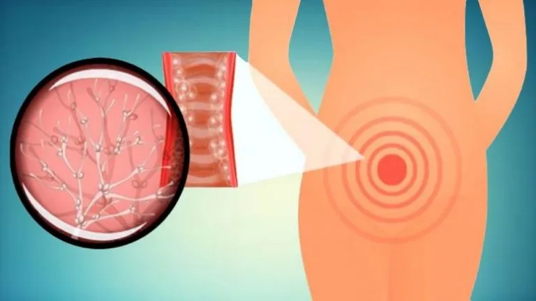 itchy pictures of yeast infection discharge look like